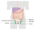 Stage 2 anal cancer