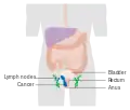 Stage 3 anal cancer