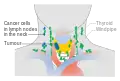 Stage N1b thyroid cancer