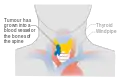 Stage T4b thyroid cancer
