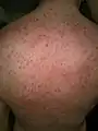 TENS Blisters on day 4