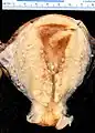 A stage III endometrioid adenocarcinoma that has invaded the myometrium