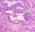 Grade 1: ≤5% solid non-glandular, non-squamous growth.