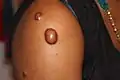 Keloid nodules (1–2 cm in diameter) and a keloid tumor >2 cm. in diameter