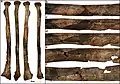 Burial 15. Perimortem fractures on the left radius
