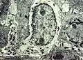 Melanocyte with melanin granules in dendrite. PMID 6200593