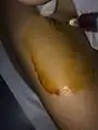 PRP is Injected into area of injury via ultrasound guidance
