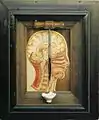 Trephining of the Skull, 1895. 36 x 30.5 x 9&nbsp;cm. MuseumZeitraum Leipzig.